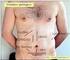INCISIONES ABDOMINALES