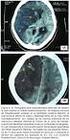 isquemia cerebral extracraneal conjunto de síntomas y signos secundarios al déficit de perfusión cerebral por lesión arterial de origen extracraneal