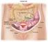 Estadificación quirúrgica del cáncer de ovario en estadios iniciales: Es posible el abordaje laparoscópico?