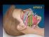 Apnea Obstructiva del Sueño