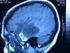Radiocirugía de Tumores Cerebrales Mayores a Cuatro Centímetros Utilizando Tomoterapia.