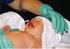 Manejo neonatal de la extrofia vesical