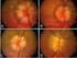 Drusas del nervio óptico y glaucoma crónico de ángulo cerrado. Reporte de un caso