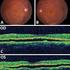 Actualización en autofluorescencia retiniana