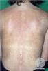 Dermatitis seborreica y pitiriasis versicolor