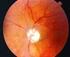Neuropatía óptica isquémica anterior no arterítica, inicialmente tratada como glaucoma. Caso clínico