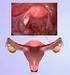 Embarazo ectópico ovárico complicado en el segundo trimestre de la gestación: a propósito de un caso