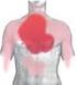 Dolor Torácico Cardiogenico (Infarto Agudo de Miocardio en pacientes con Elevación del Segmento ST)