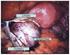 Laparoscopia frente a laparotomía en el manejo de los teratomas de ovario