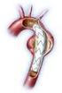 Problemas con las endoprótesis para aorta torácica