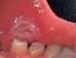 Fiebre periódica asociada a estomatitis aftosa, faringitis y adenitis cervical (PFAPA)