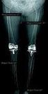 Estudio comparativo con prótesis total de rodilla de alta flexión