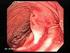 Sangrado Activo en Angio-TC del Tracto Gastrointestinal: El AngioTC sirve para algo?