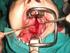 Manejo quirúrgico del angiofibroma nasofaríngeo juvenil