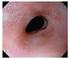 Análisis de las estenosis esofágicas posteriores a intervenciones de atresia de esófago