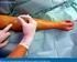 lesión nerviosa periférica secundaria a anestesia regional subaracnoidea en paciente ginecobstétrica