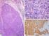 Características inmunohistoquímicas de los tumores cerebrales