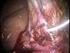 Complicaciones de la colecistectomía laparoscópica en el Hospital Nacional Sergio E. Bernales