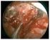 Parálisis del nervio abducens secundario a meningioma del canal de Dorello: Consideraciones anatómicas por resonancia magnética