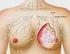 El espectro de las asimetrías en la mama: características radiológicas, estudio diagnóstico y tratamiento