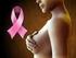 Existe el carcinoma de mama con fenotipo basal?