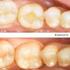 Para la obturación de dientes cariosos por profesionales de la odontología. 5-9 Brunsdon Street, Bayswater 729 N.Route 83, Suite 315