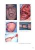 Invasión perineural del nervio facial: Hallazgos en imagen