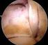 Vía posterior tricipital que conserva el tendón del músculo tríceps