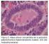 Diagnostico Histopatológico en Pacientes con Carcinoma de Endometrio Histopathological Diagnosis in Patients with Endometrium Carcinoma