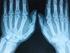 Artritis psoriásica: lo que el dermatólogo debe saber (Parte 1)