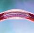 Tratamiento con angioplastia e implante de stent versus tratamiento quirúrgico en pacientes con estenosis de la arteria carótida cervical