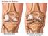 Padece dolor de rodilla por osteoartritis?