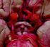 Aneurismas del complejo arteria cerebral anterior / arteria comunicante anterior. Resultados del tratamiento quirúrgico