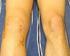Lesiones de los ligamentos de la rodilla