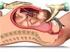 Morbilidad neonatal en el parto instrumentado