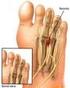 Los nervios interdigitales son los que están entre los dedos y que se encargan de la sensibilidad de los dedos de los pies.
