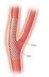 Angioplastia y stent carotideo con sistema de proteccion proximal MO.MA