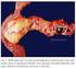 Tumor papilar, mucinoso e intraductal: abordaje diagnóstico y terapéutico