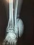 FRACTURA COMPLEJA DEL EXTREMO DISTAL DE LA TIBIA