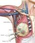 Cáncer de la mama metastásico en ganglio linfático intramamario: a propósito de cuatro casos