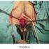 Histerectomía Vaginal