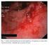 Análisis de una serie de casos de hemorragia digestiva grave ingresadas en una UTI polivalente