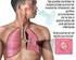 se produce cuando el bacilo afecta a los pulmones, cuya transmisión de persona a persona se propaga por contacto directo y cercano a través del aire,