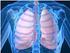 Qué son las exacerbaciones pulmonares?