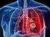 Alteraciones vasculares del pulmon
