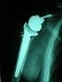 Artroplastia reversa de hombro