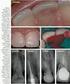 PROCESOS DESTRUCTIVOS DENTARIOS POR REABSORCIÓN