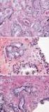 Revisión de los adenocarcinomas de próstata con patrón pseudohiperplásico y pseudoatrófico