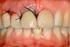 Implantes orales, carga inmediata, oclusión, prótesis fija provisional, implantología oral, maxilar superior.