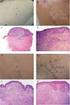 Correlación dermatoscópico-histopatológica de lesiones pigmentadas melanocíticas y no melanocíticas de piel